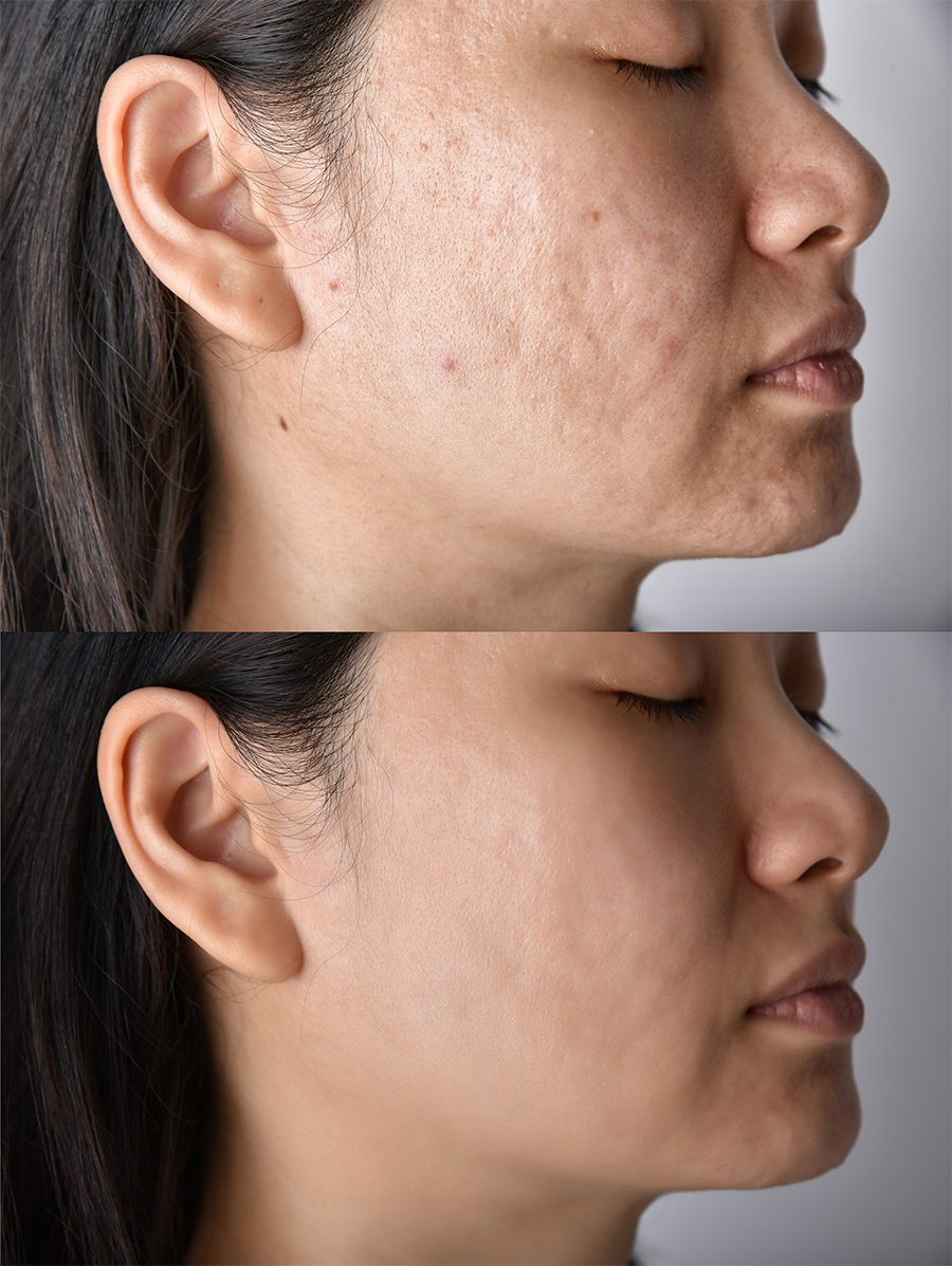 Acne before and after treatment