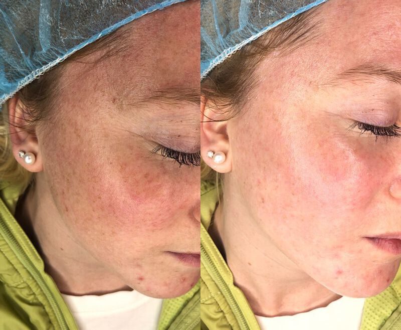 Dermaplaning before and after