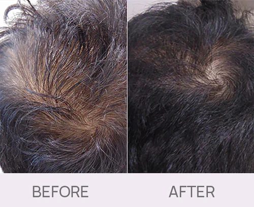 Hair growth stimulation before and after
