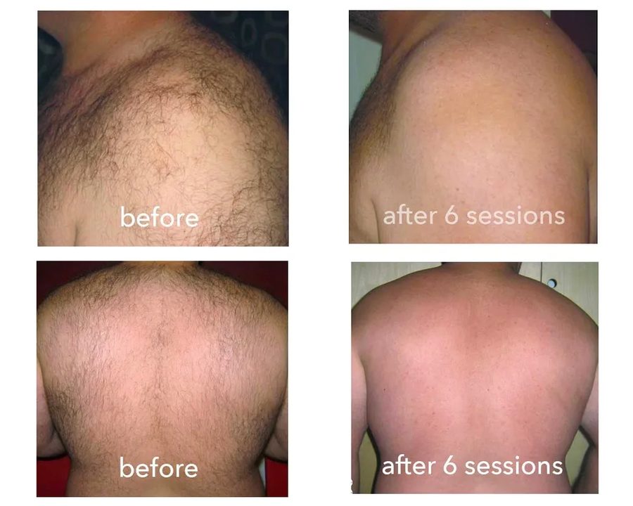 Full back laser hair removal, before and after six sessions