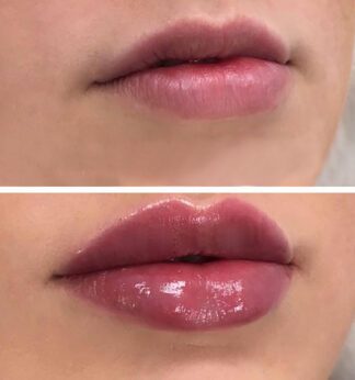 Lips before and after hyaluron pen filler