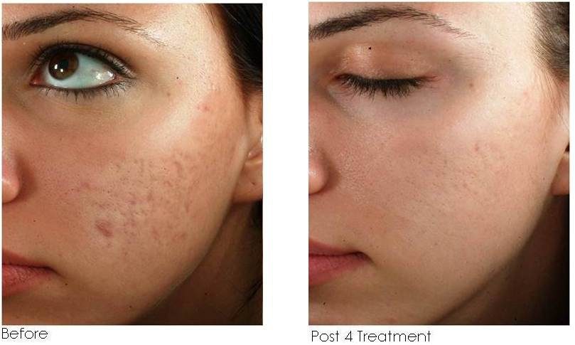Acne scars before and after four microneedling sessions