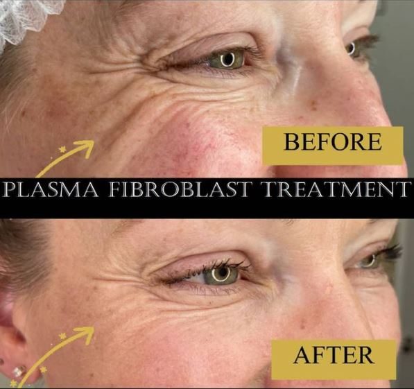 Plasma fibroblast before and after around the eyes