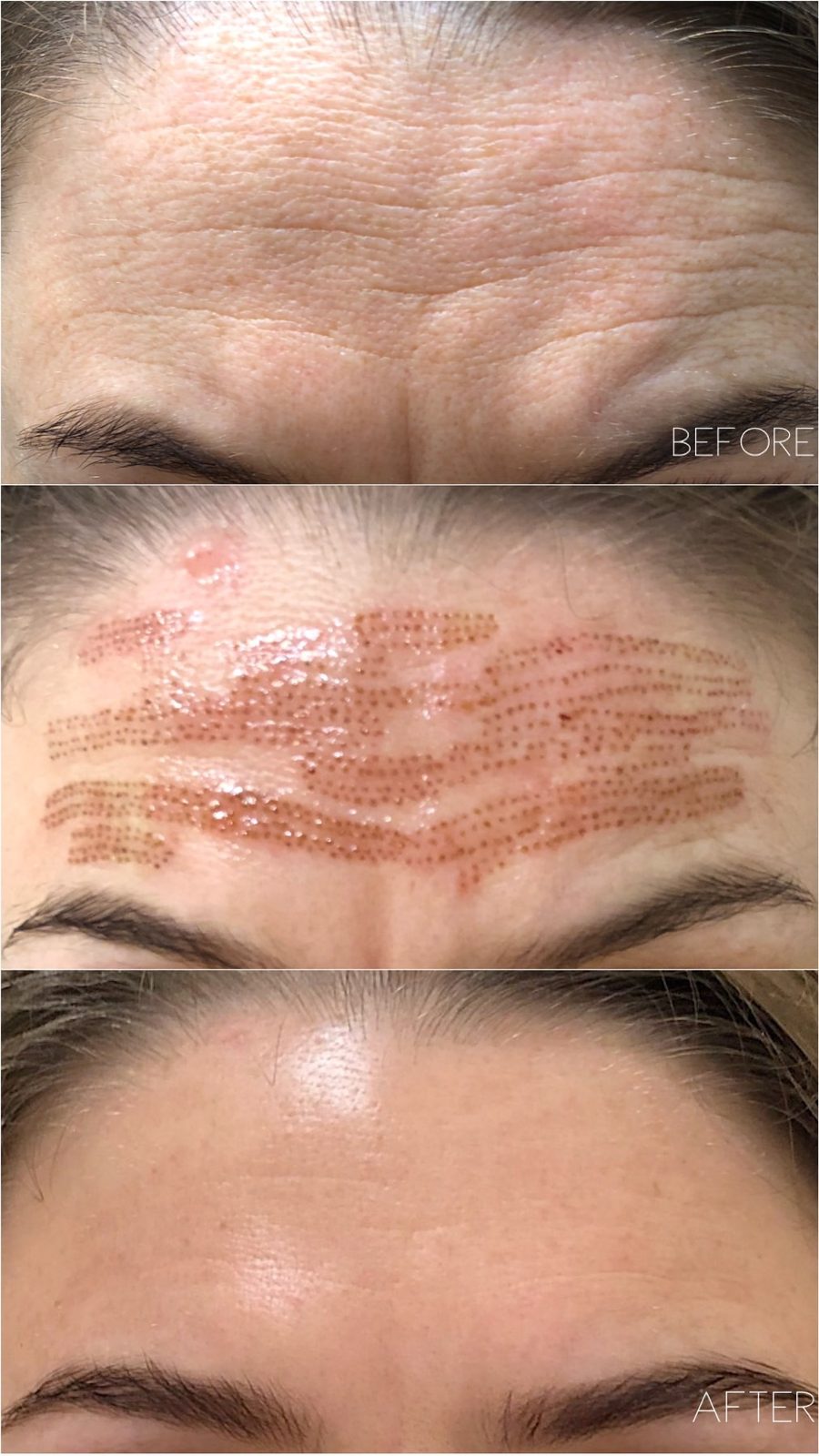 Plasma fibroblast on the forehead, before and after