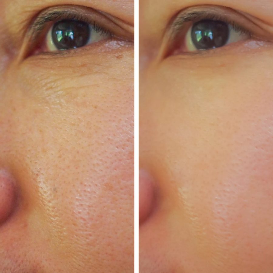 Pores before and after treatment
