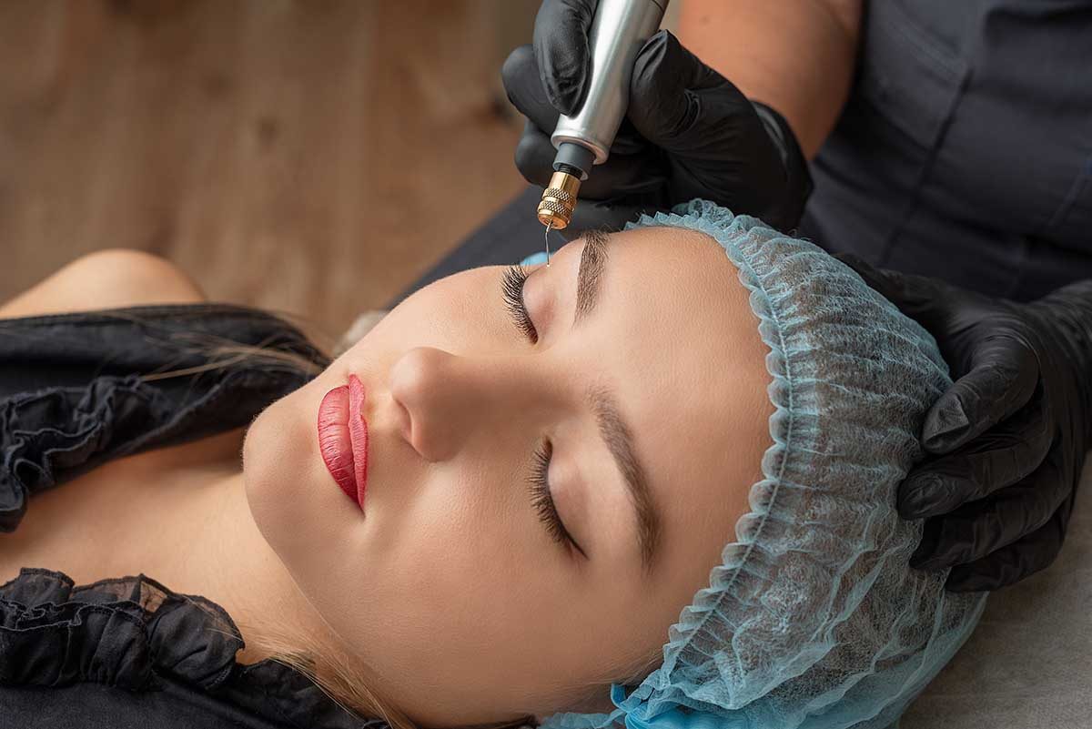Microneedling treatment in progress