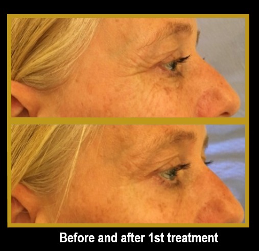Mezotix before after eyes 3