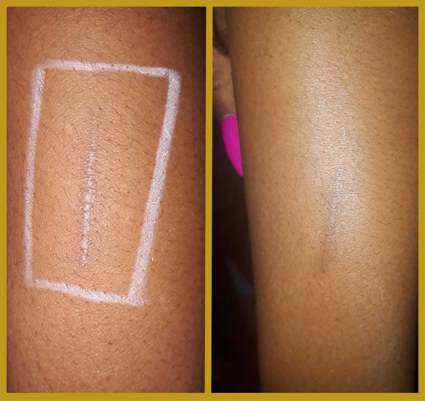 Mezotix scar treatment